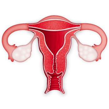 Uterus bleeding